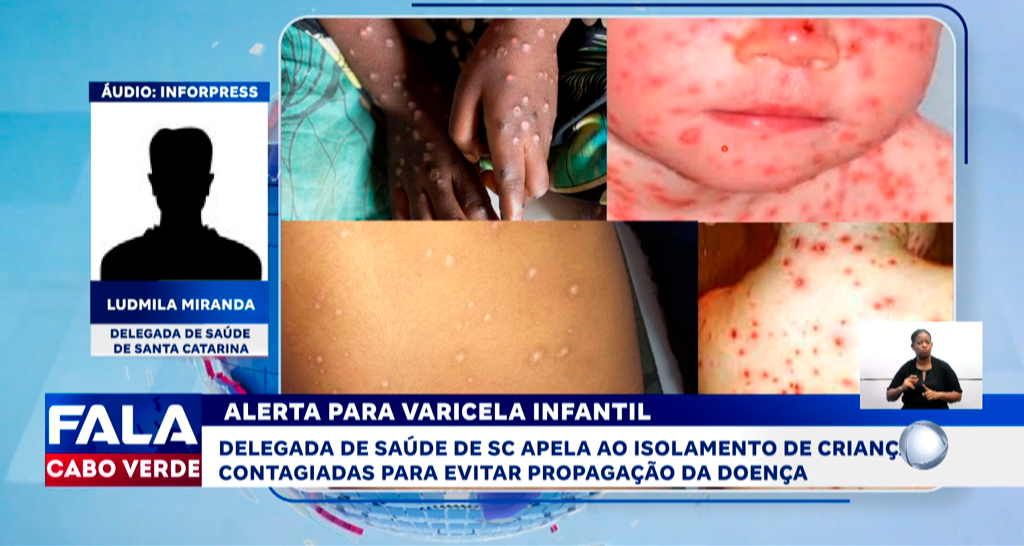 ALERTA PARA VARICELA INFANTIL