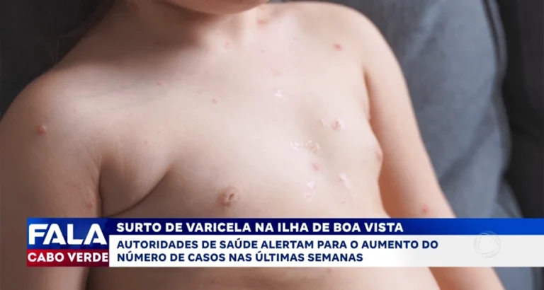 SURTO DE VARICELA NA ILHA DE BOA VISTA